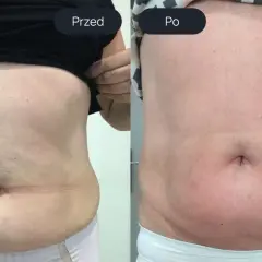 Porównanie brzucha przed i po zabiegu endermologii.