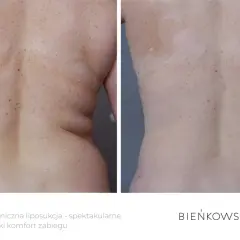 Liposukcja: Co to? Twój przewodnik po metodach, kosztach i ryzyku