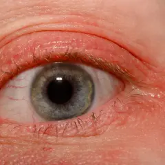 Alergia na rzęsy? Objawy, leczenie i bezpieczne alternatywy!