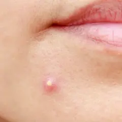 Pryszcze: Co naprawdę pomaga? Od domowych po dermatologa