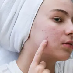 Dziewczyna z ręcznikiem na głowie wskazuje palcem na pryszcze na policzku.