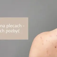 Pryszcze na plecach? Jak się ich pozbyć? Poradnik eksperta!