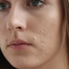 Sudocrem na pryszcze: Pomoc czy ryzyko? Co mówią eksperci?
