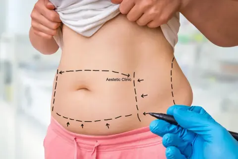Liposukcja: czy przytyjesz? Sekrety trwałej sylwetki