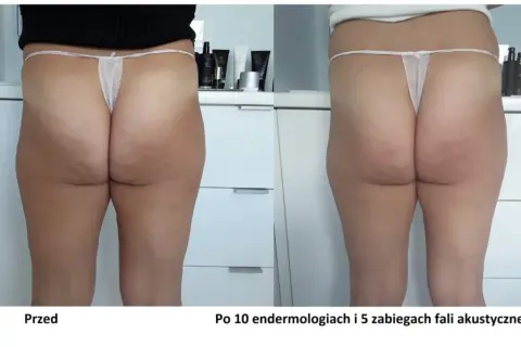 Endermologia: Jak często, by efekty były trwałe?