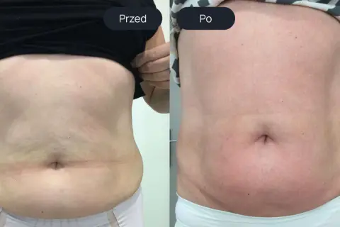 Porównanie brzucha przed i po zabiegu endermologii.