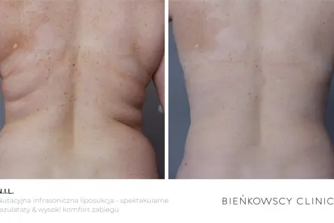 Liposukcja: Co to? Twój przewodnik po metodach, kosztach i ryzyku