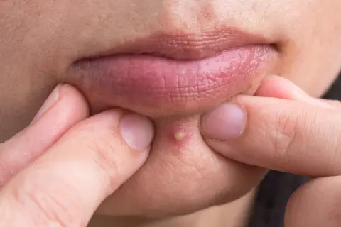 Jak nie mieć pryszczy? Ekspert radzi: pielęgnacja i dieta