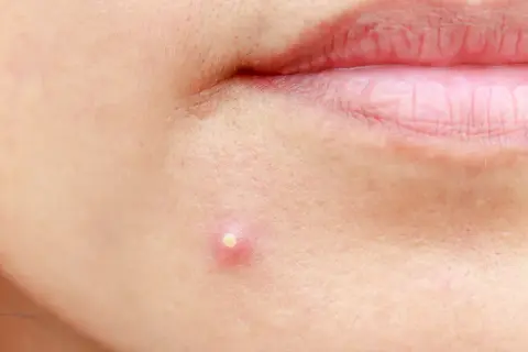 Pryszcze: Co naprawdę pomaga? Od domowych po dermatologa