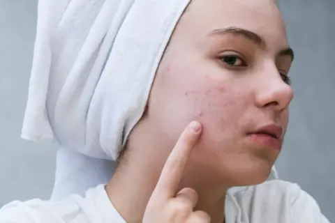 Dziewczyna z ręcznikiem na głowie wskazuje palcem na pryszcze na policzku.