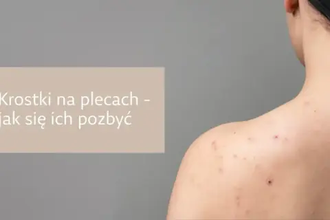 Pryszcze na plecach? Jak się ich pozbyć? Poradnik eksperta!