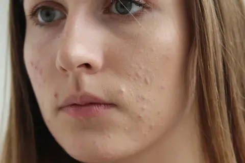 Sudocrem na pryszcze: Pomoc czy ryzyko? Co mówią eksperci?