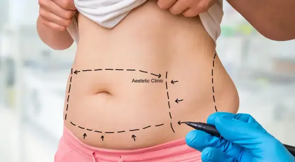 Liposukcja: czy przytyjesz? Sekrety trwałej sylwetki