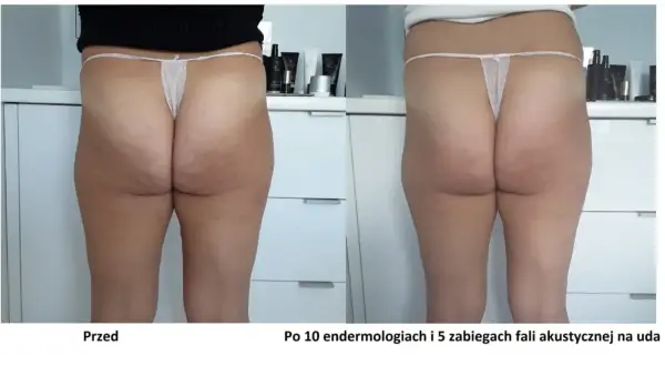 Endermologia: Jak często, by efekty były trwałe?
