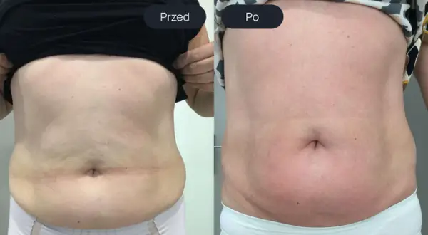 Porównanie brzucha przed i po zabiegu endermologii.