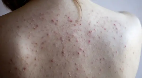 Co na pryszcze na plecach? Skuteczne sposoby i leczenie bacne