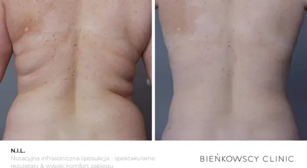 Liposukcja: Co to? Twój przewodnik po metodach, kosztach i ryzyku