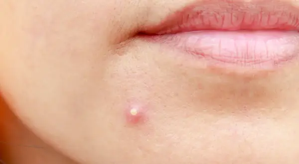 Pryszcze: Co naprawdę pomaga? Od domowych po dermatologa