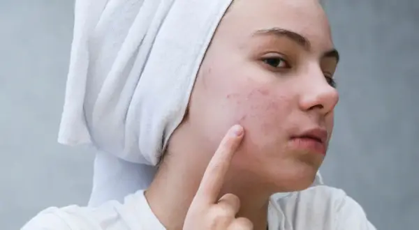 Dziewczyna z ręcznikiem na głowie wskazuje palcem na pryszcze na policzku.