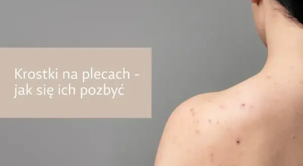 Pryszcze na plecach? Jak się ich pozbyć? Poradnik eksperta!