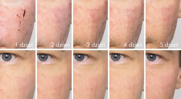 Jak wygląda skóra po depilacji laserowej? Od reakcji do gładkości.