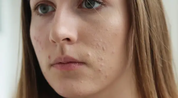 Sudocrem na pryszcze: Pomoc czy ryzyko? Co mówią eksperci?