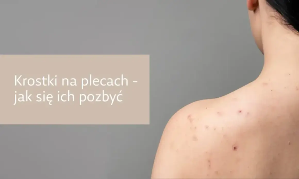 Pryszcze na plecach? Jak się ich pozbyć? Poradnik eksperta!