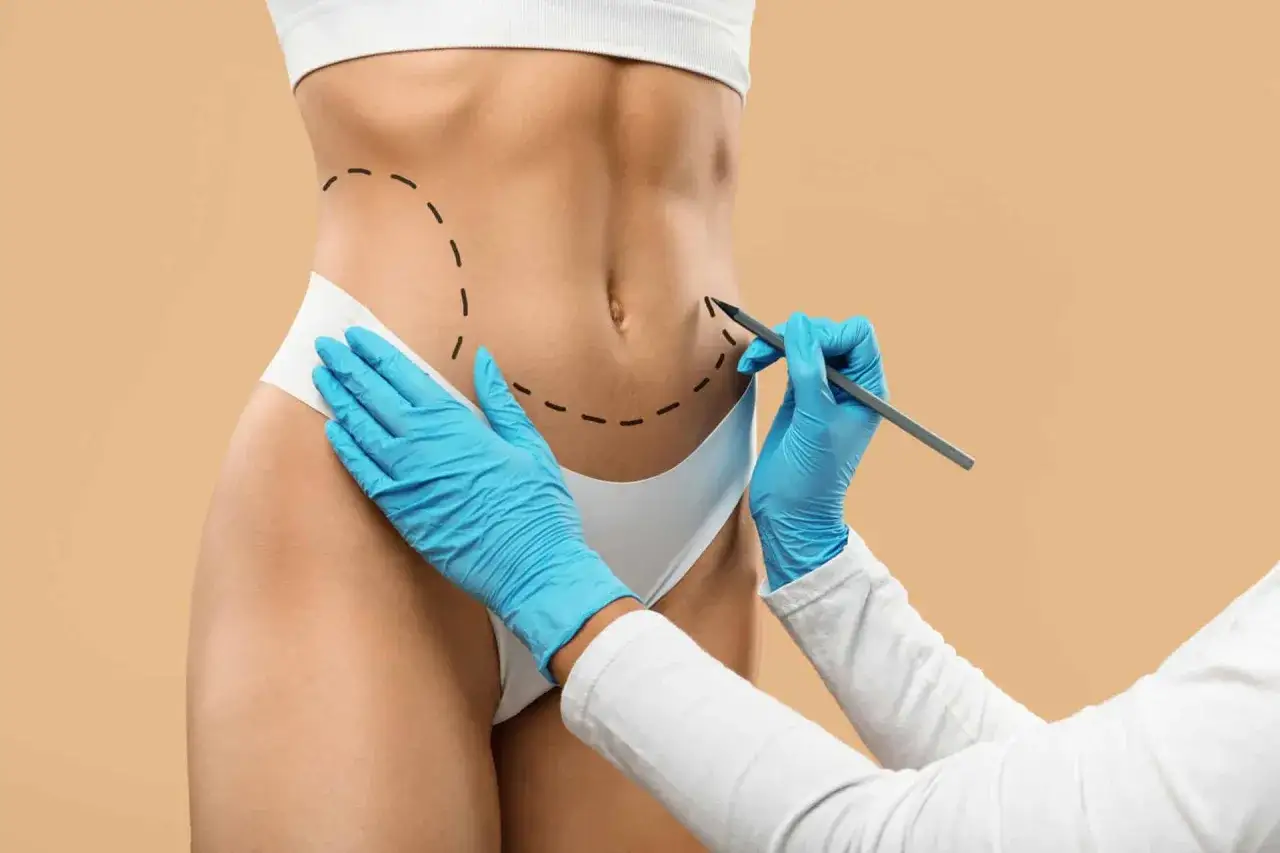 Liposukcja definicja