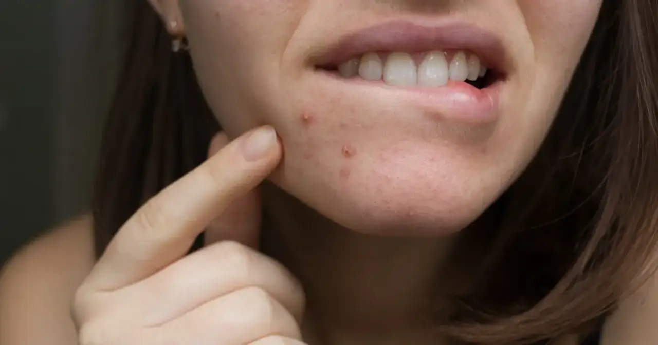 Kiedy iść do dermatologa z pryszczami