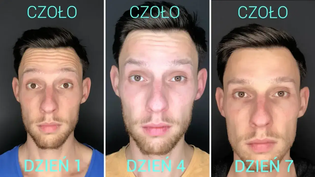 botoks czoło przed po