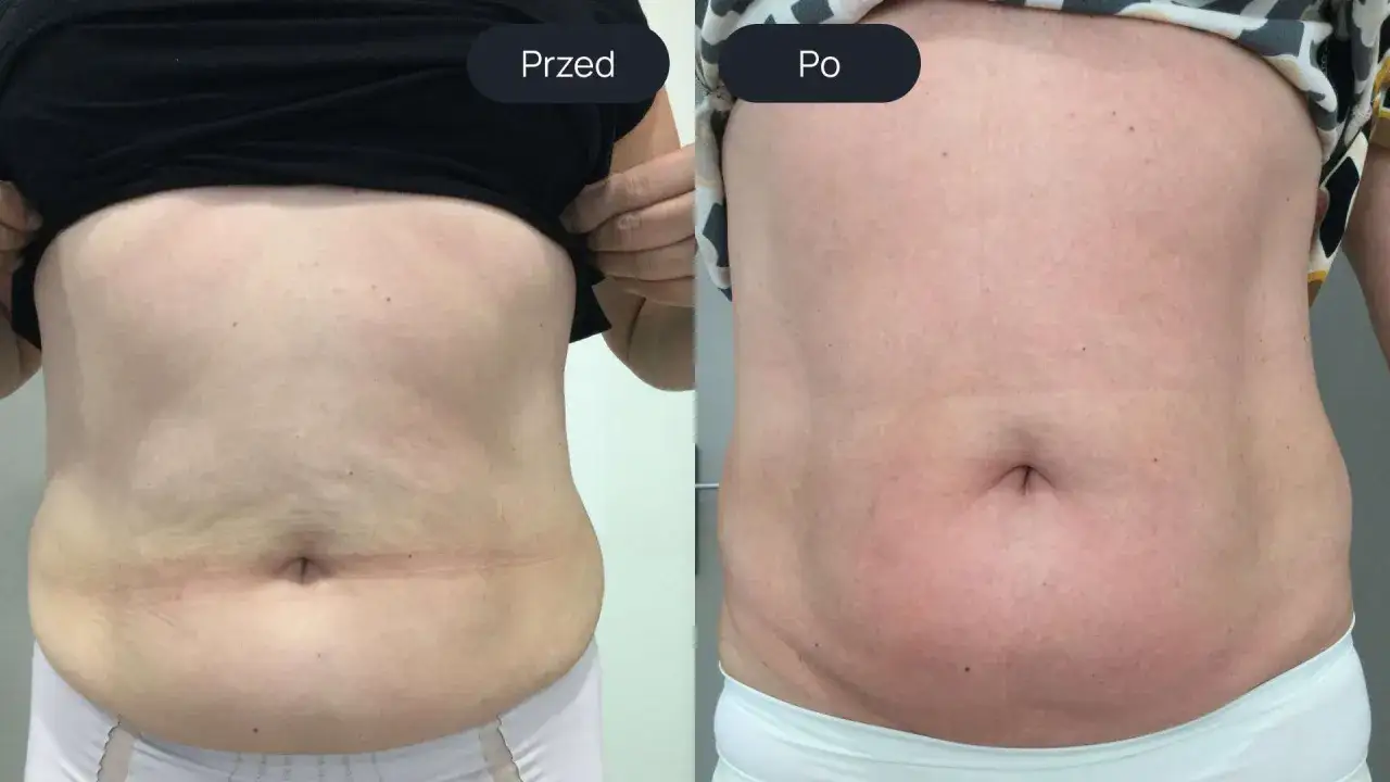 endermologia efekty przed i po realne