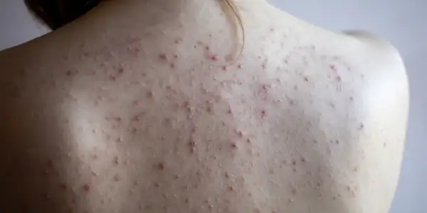 Co na pryszcze na plecach? Skuteczne sposoby i leczenie bacne