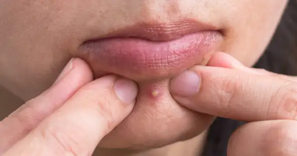 Jak nie mieć pryszczy? Ekspert radzi: pielęgnacja i dieta