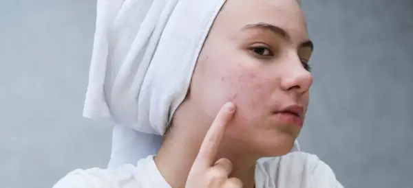 Dziewczyna z ręcznikiem na głowie wskazuje palcem na pryszcze na policzku.
